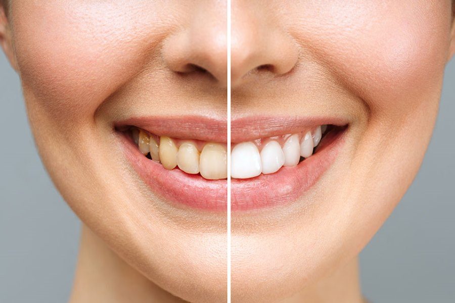 Clareamento Dental